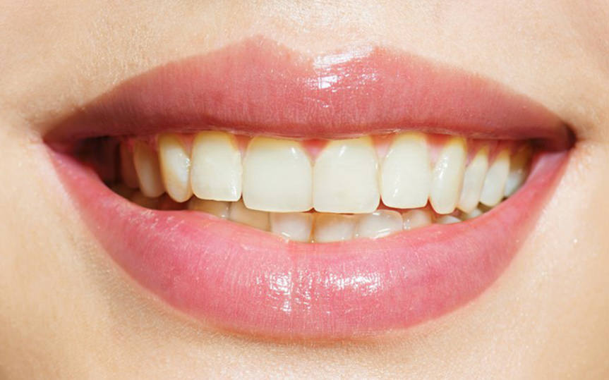 Before-Teeth Whitening 